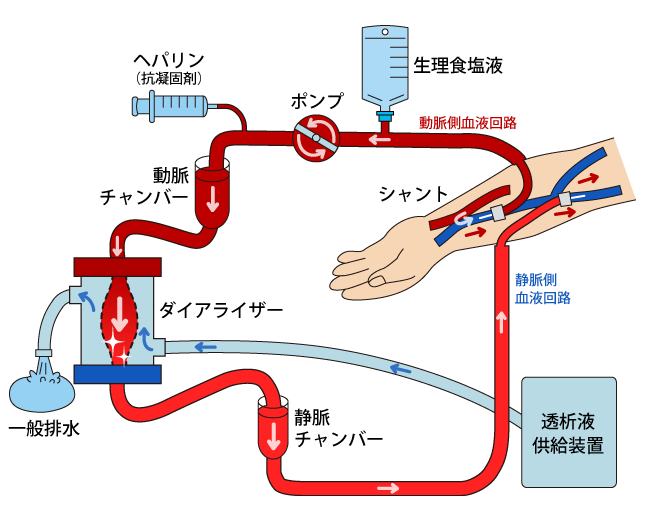 人工透析・血液透析療法（ＨＤ）ダイアライザー