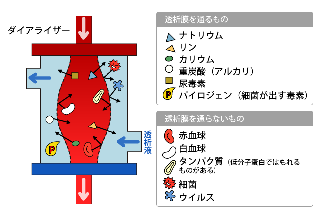 人工透析・血液透析療法（ＨＤ）ダイアライザー