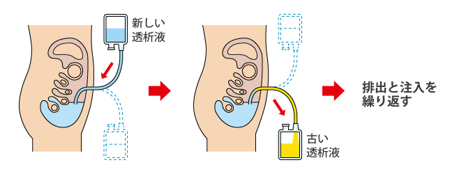 腹膜透析療法(PD)カテーテルと透析液の排出と注入