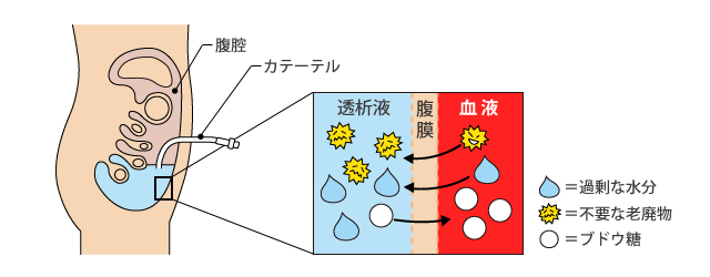 腹膜透析療法(PD)腹膜を通した透析液と血液の移動