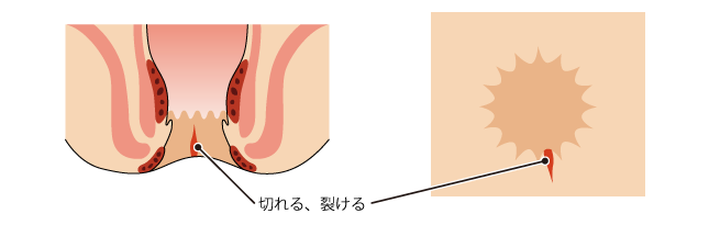 裂肛(切れ痔)の肛門断面図