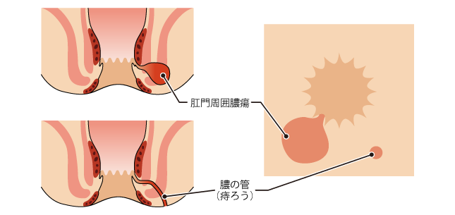 肛門周囲膿瘍、痔ろうの肛門断面図