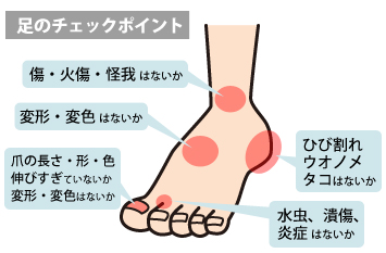 糖尿病足のケアチェックポイント